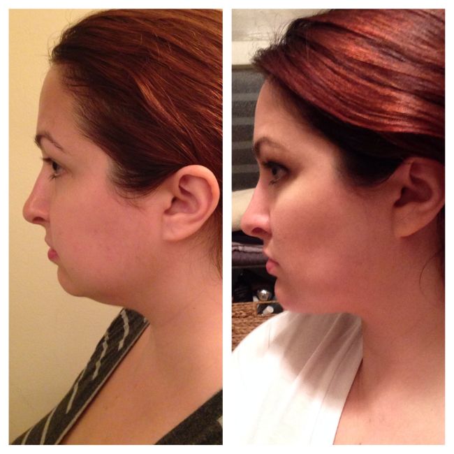 My Beauty Bunny Jen Plastic Surgery