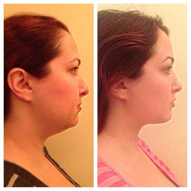 My Beauty Bunny Jen Plastic Surgery