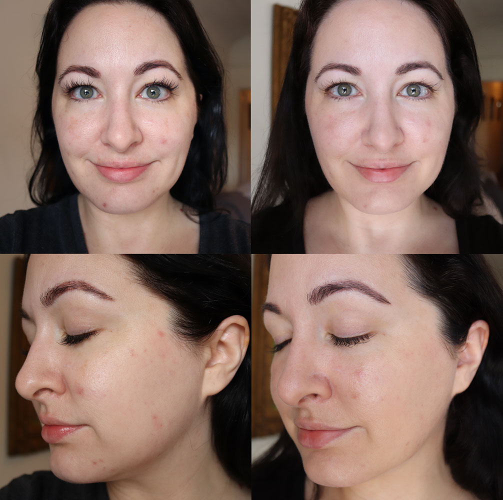 Banish Skincare - Cruelty Free Acne Scar Treatment - Before and After