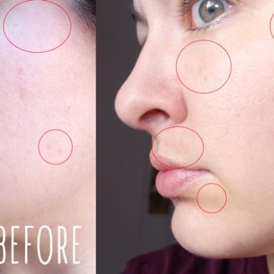 I Tried It! Clear and Brilliant Laser Treatment