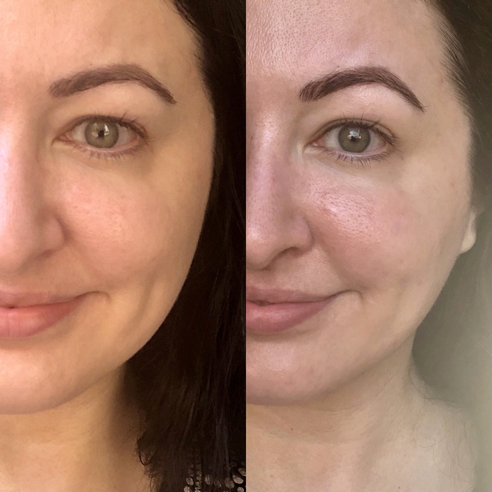 Verabella Microcurrent Before and After