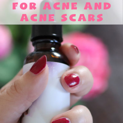 DIY Recipes for Acne and Acne Scars