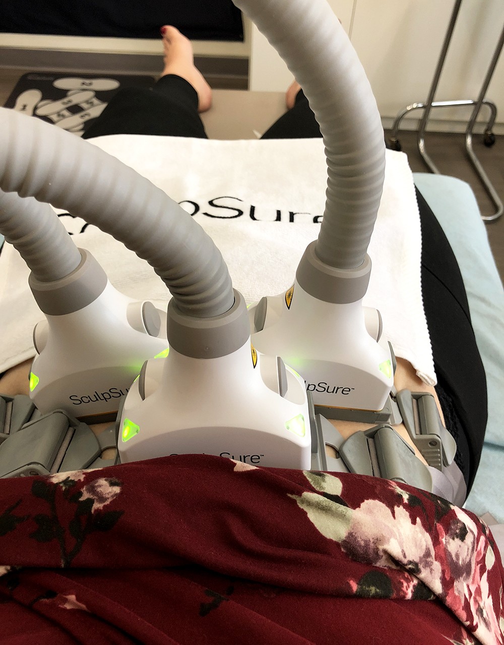 Upper Abdomen SculpSure Treatment at LaserXX - Review