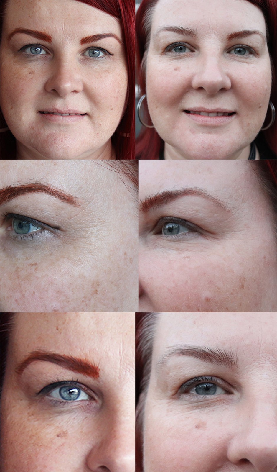 Skin Laundry Ultra Fractional Laser Treatment Review - Before and After