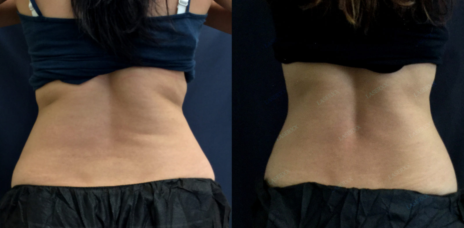SculpSure Before and After LaserXX med spa in Los Angeles