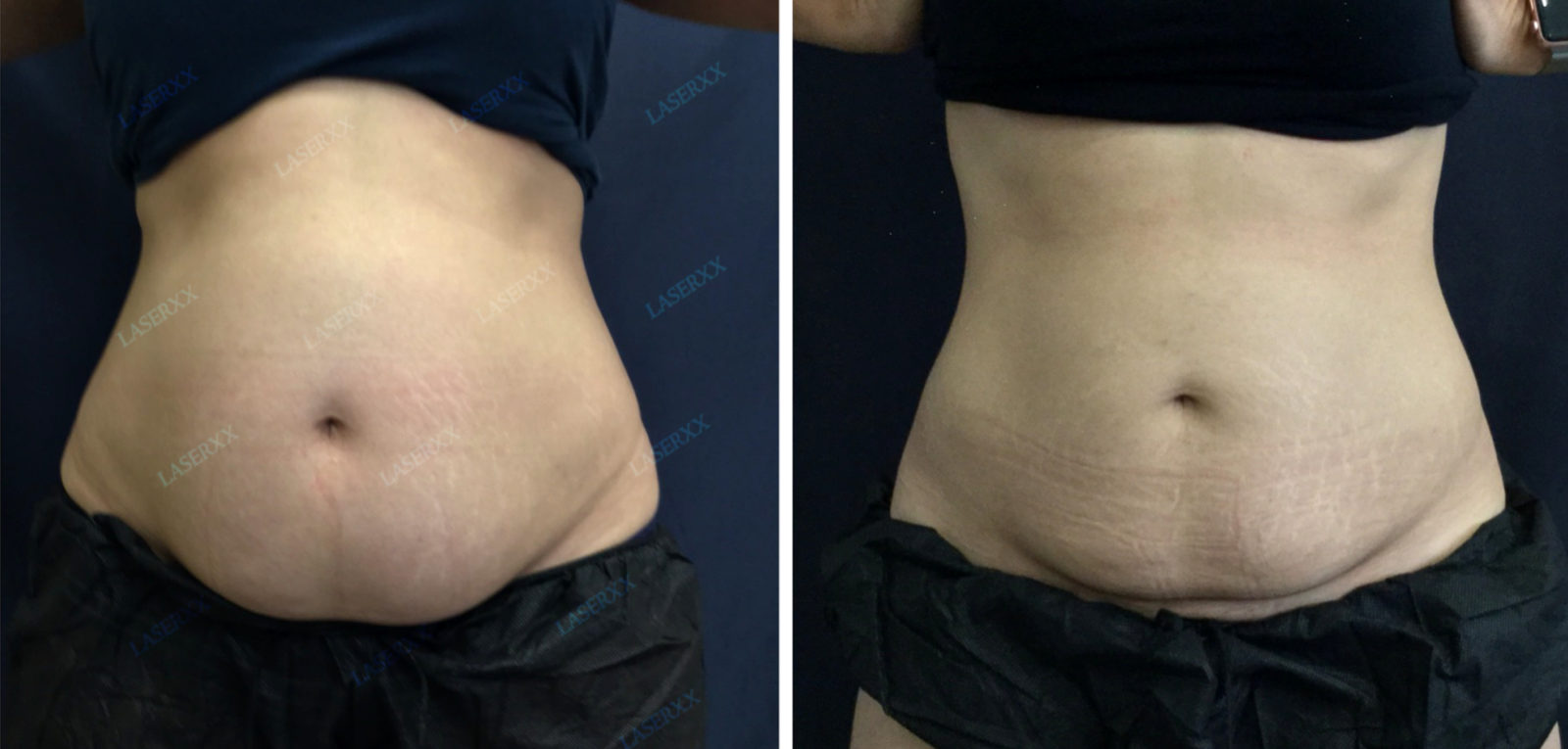 SculpSure Before and After LaserXX med spa in Los Angeles